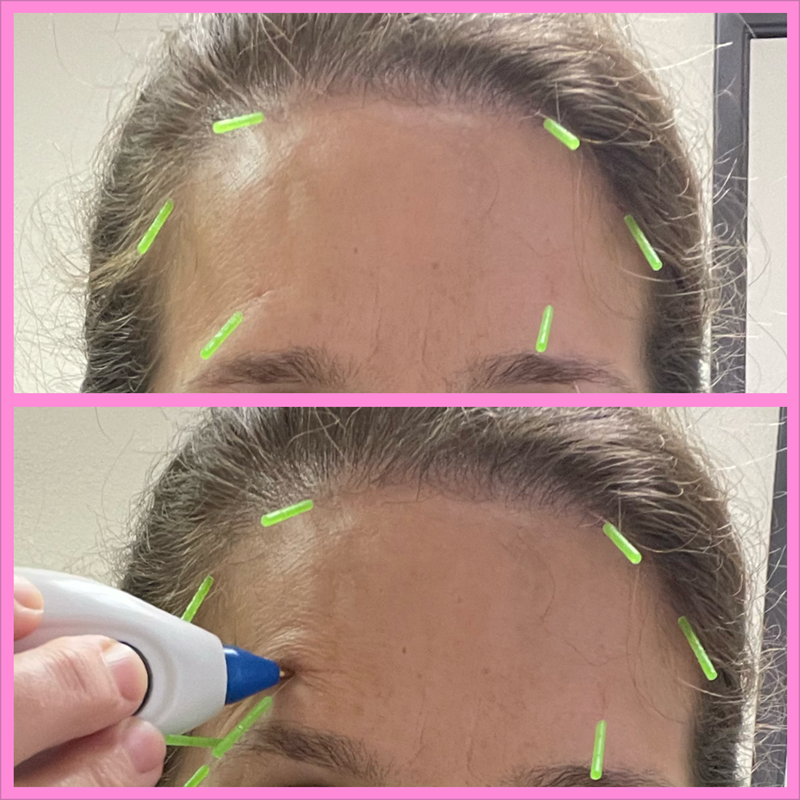 radiant acupuncture on forehead